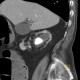 Nephrolithiasis, kidney stones, hydronephrosis, pyelonephritis, chronic: CT - Computed tomography